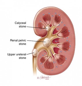 anatomy_KidneyStones