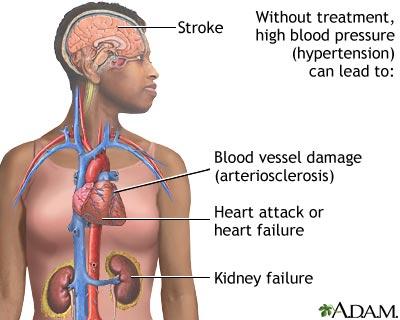hypertensive-heart