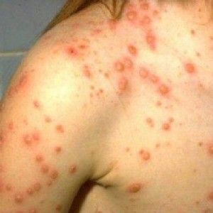 Natural Home Remedies for Chickenpox