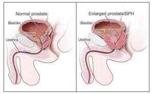Natural Treatments for Reducing Enlarged Prostate