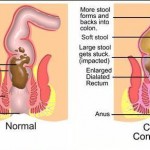 Constipation’s Natural Remedies