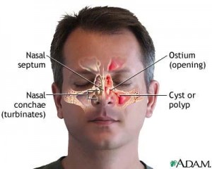 Effective Natural Home Remedies for Sinusitis